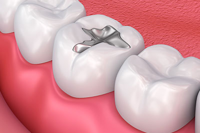 Scott E. Learn, DMD | Dentures, Root Canals and Night Guards