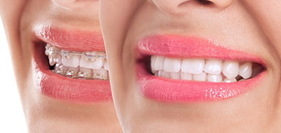 Scott E. Learn, DMD | Sports Mouthguards, Inlays  amp  Onlays and Veneers