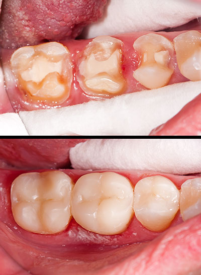 Scott E. Learn, DMD | TMJ Disorders, Dermal Fillers and Fluoride Treatment