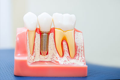 Scott E. Learn, DMD | Root Canals, Sports Mouthguards and Oral Exams