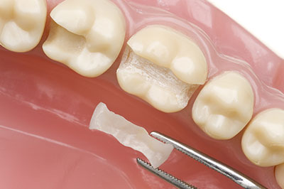 Scott E. Learn, DMD | Crowns, Digital Impressions and Veneers