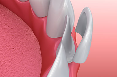 Scott E. Learn, DMD | All-on-4 reg , Veneers and Dental Bridges