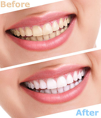 Scott E. Learn, DMD | Ceramic Crowns, Implant Dentistry and Digital Impressions