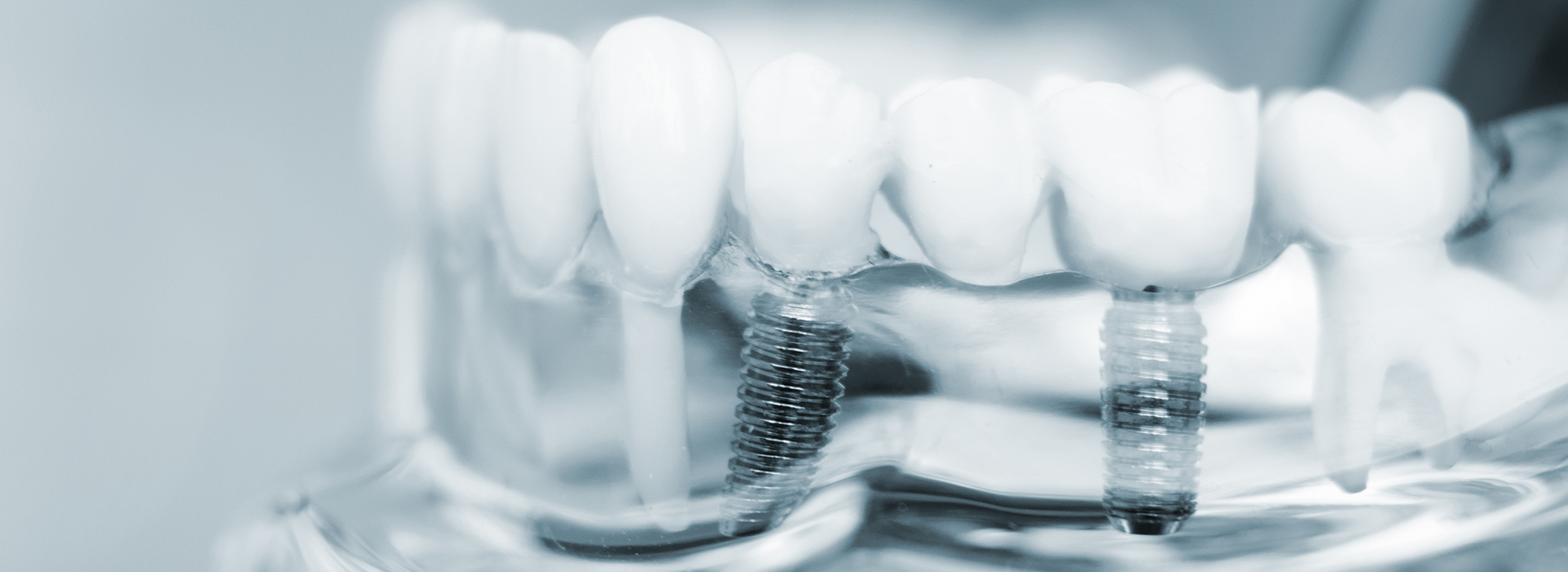 Scott E. Learn, DMD | Oral Exams, All-on-6 reg  and Crowns