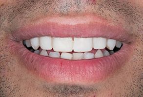 Scott E. Learn, DMD | Dentures, Teeth Whitening and Dermal Fillers