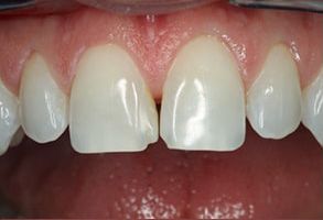 Scott E. Learn, DMD | Inlays  amp  Onlays, Invisalign reg  and Implant Restorations